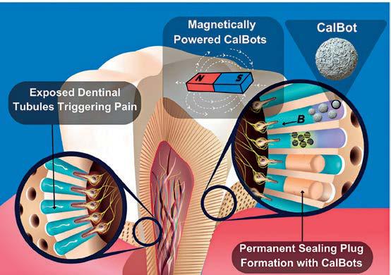 TOOTH SENSITIVITY NANOBOTS TO THE RESCUE